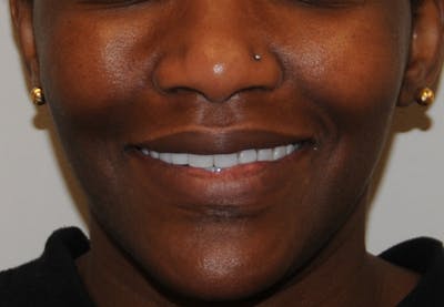 Dimple Creation Before & After Gallery - Patient 391675 - Image 1