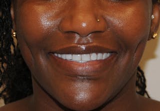 Dimple Creation Before & After Gallery - Patient 391675 - Image 2