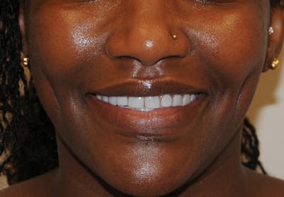 Dimple Creation Before & After Gallery - Patient 391675 - Image 2