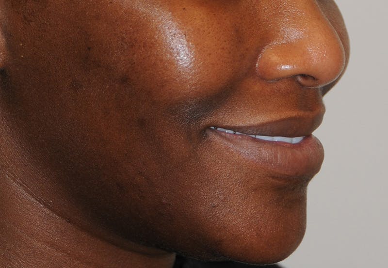 Dimple Creation Before & After Gallery - Patient 391675 - Image 3