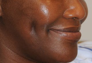 Dimple Creation Before & After Gallery - Patient 391675 - Image 4