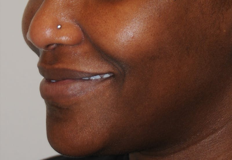 Dimple Creation Before & After Gallery - Patient 391675 - Image 5