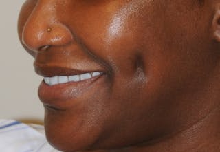 Dimple Creation Before & After Gallery - Patient 391675 - Image 6