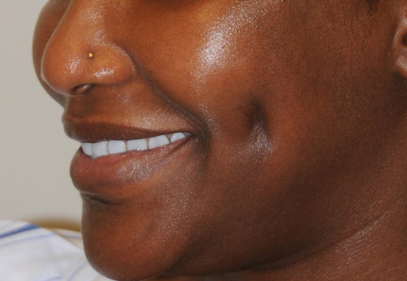 Dimple Creation Before & After Gallery - Patient 391675 - Image 6