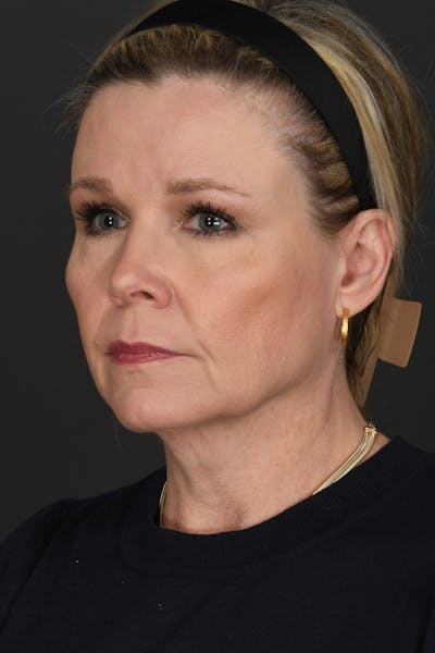 Facelift Before & After Gallery - Patient 314671 - Image 1