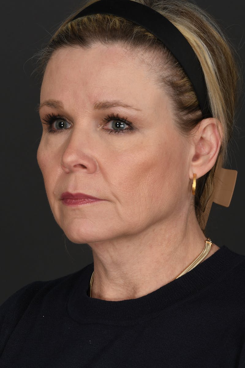 Facelift Before & After Gallery - Patient 314671 - Image 1