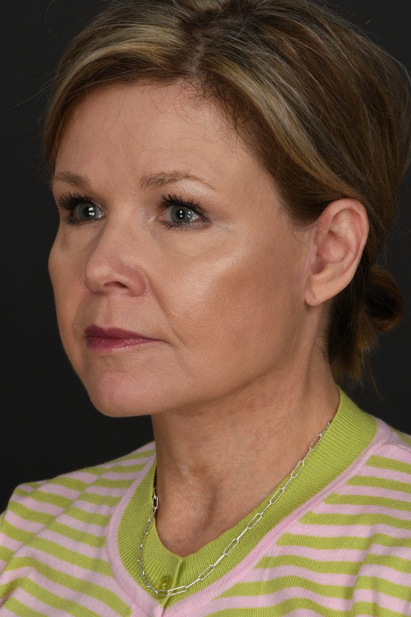 Facelift Before & After Gallery - Patient 314671 - Image 2