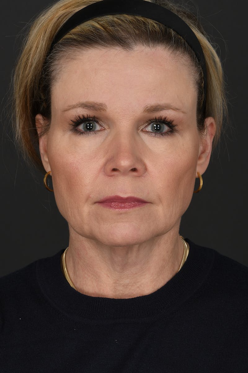 Facelift Before & After Gallery - Patient 314671 - Image 3