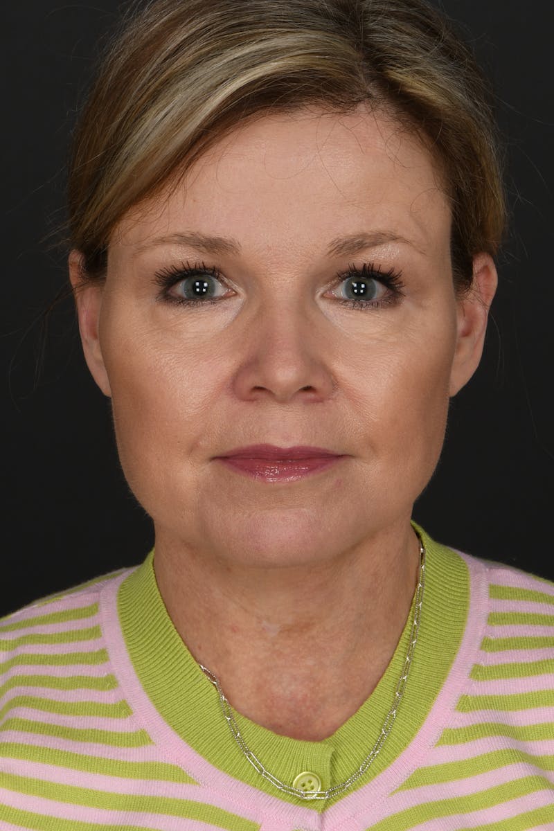 Facelift Before & After Gallery - Patient 314671 - Image 4