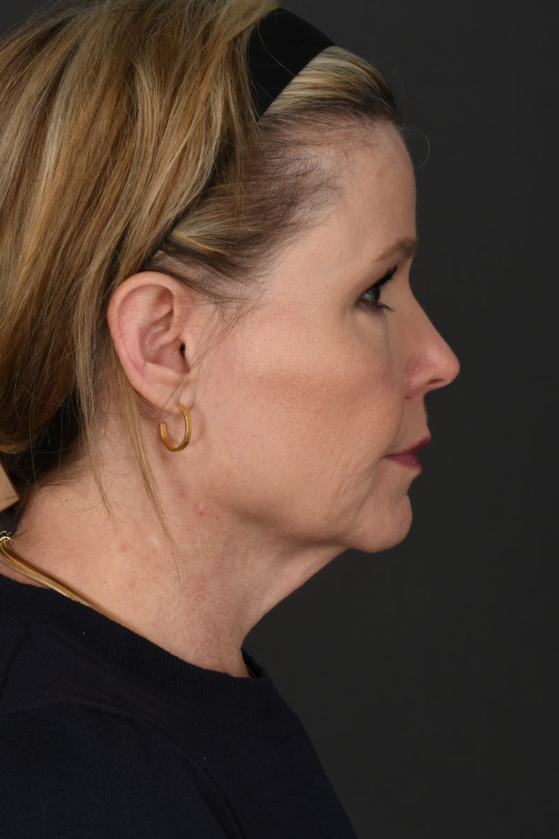 Facelift Before & After Gallery - Patient 314671 - Image 5