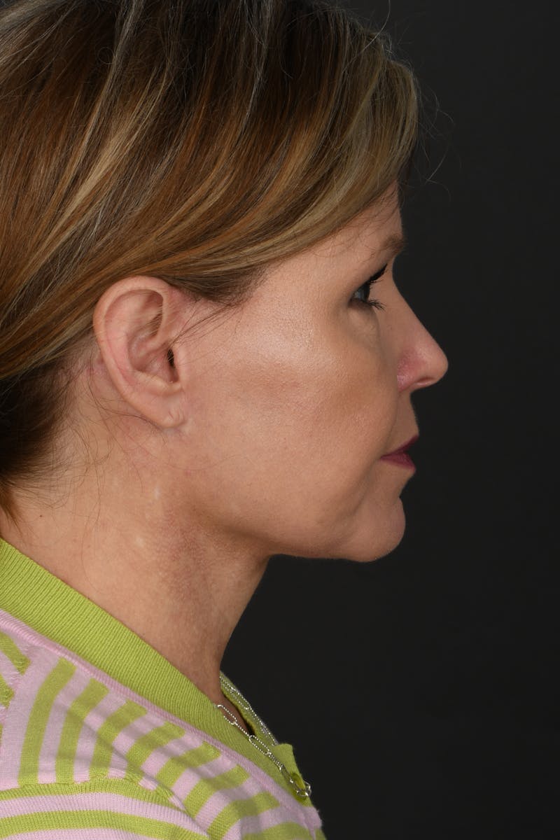 Facelift Before & After Gallery - Patient 314671 - Image 6