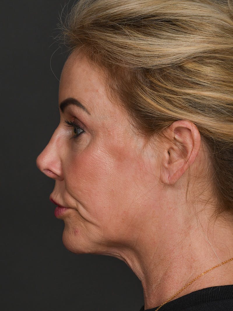 Facelift Before & After Gallery - Patient 294359 - Image 5