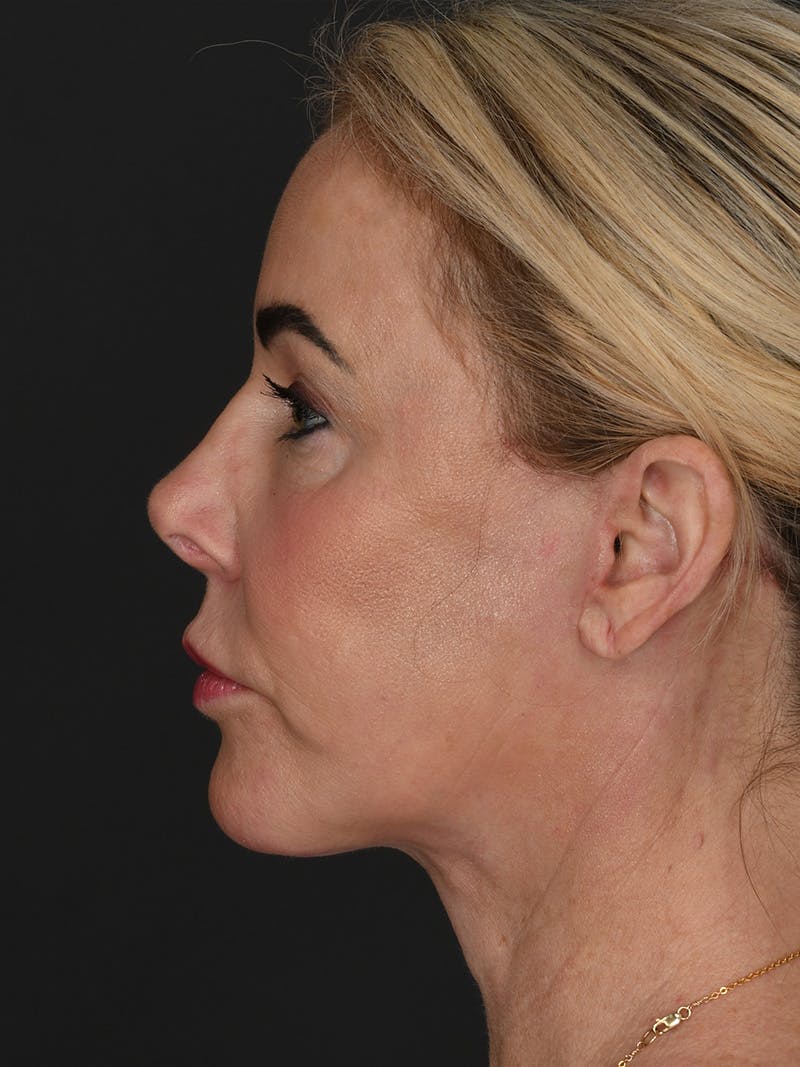 Facelift Before & After Gallery - Patient 294359 - Image 6