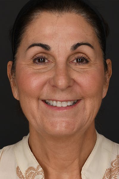 Facelift Before & After Gallery - Patient 289131 - Image 1