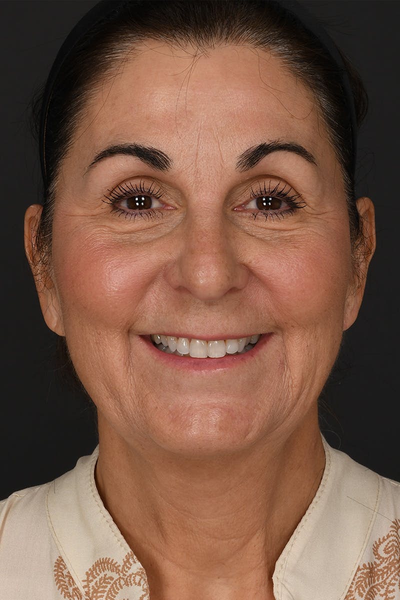 Facelift Before & After Gallery - Patient 289131 - Image 1