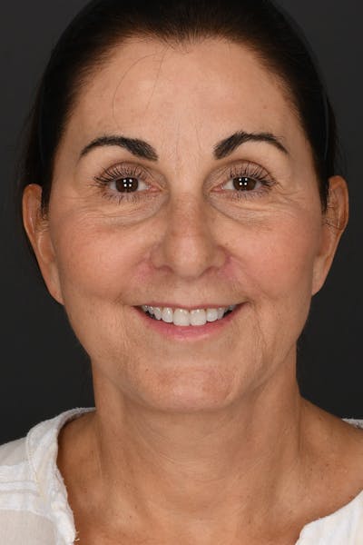 Facelift Before & After Gallery - Patient 289131 - Image 2