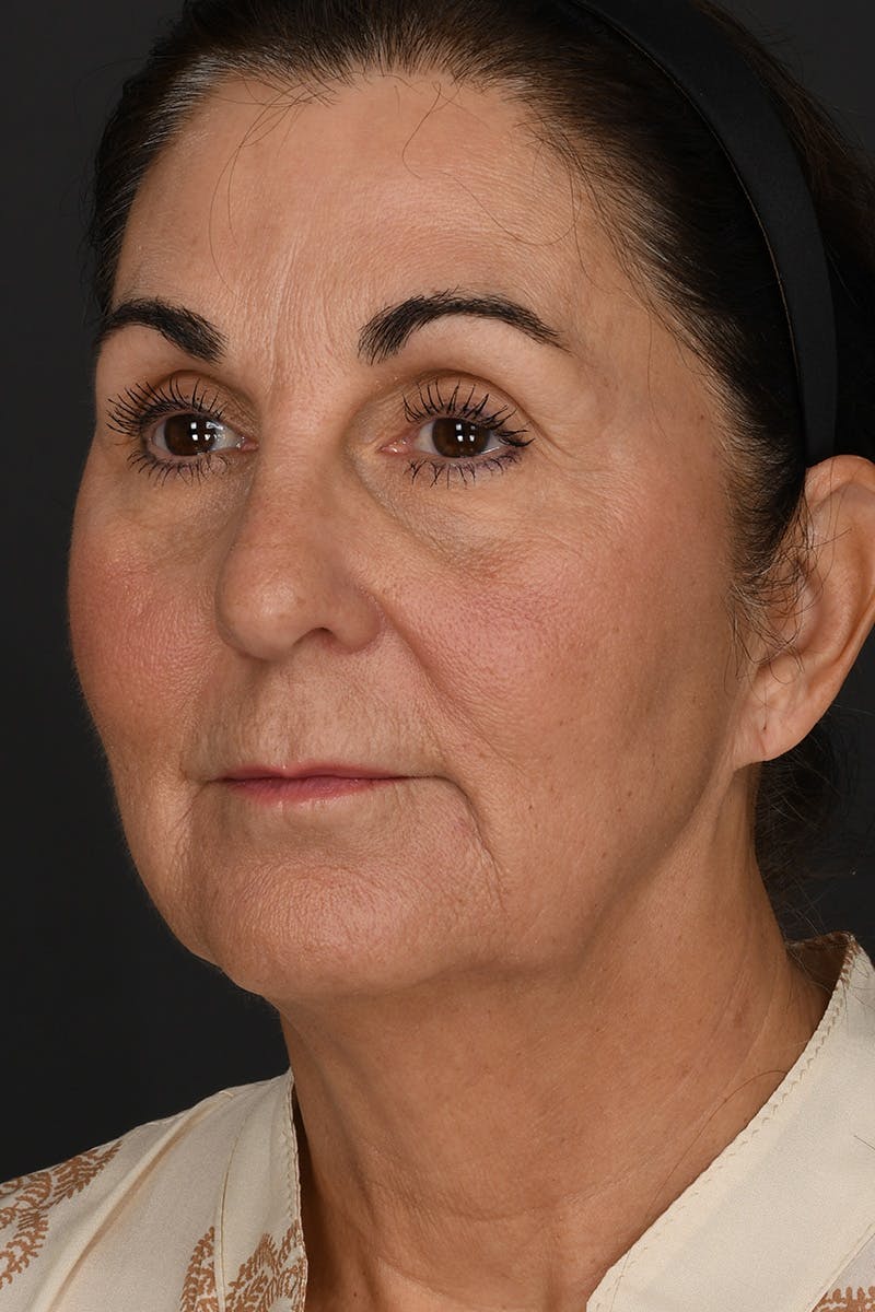 Facelift Before & After Gallery - Patient 289131 - Image 3