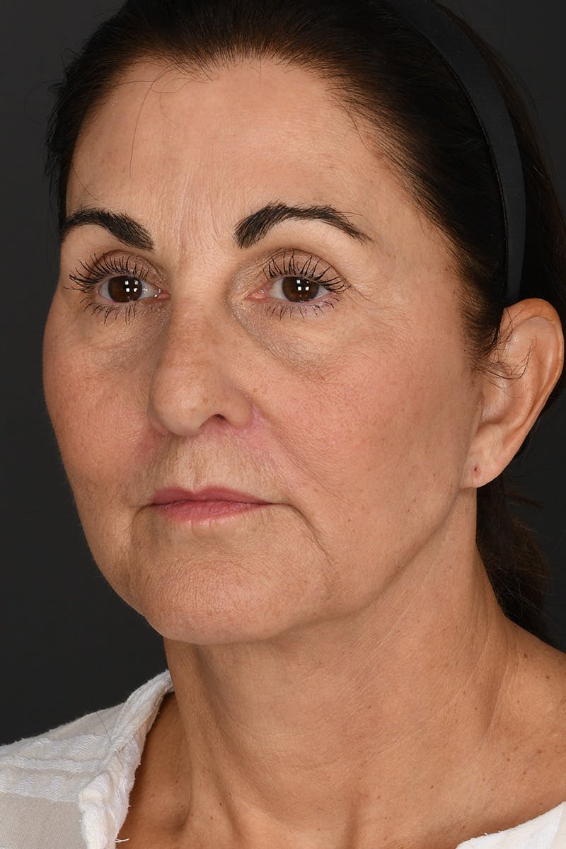 Facelift Before & After Gallery - Patient 289131 - Image 4