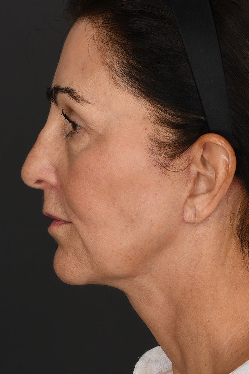 Facelift Before & After Gallery - Patient 289131 - Image 6