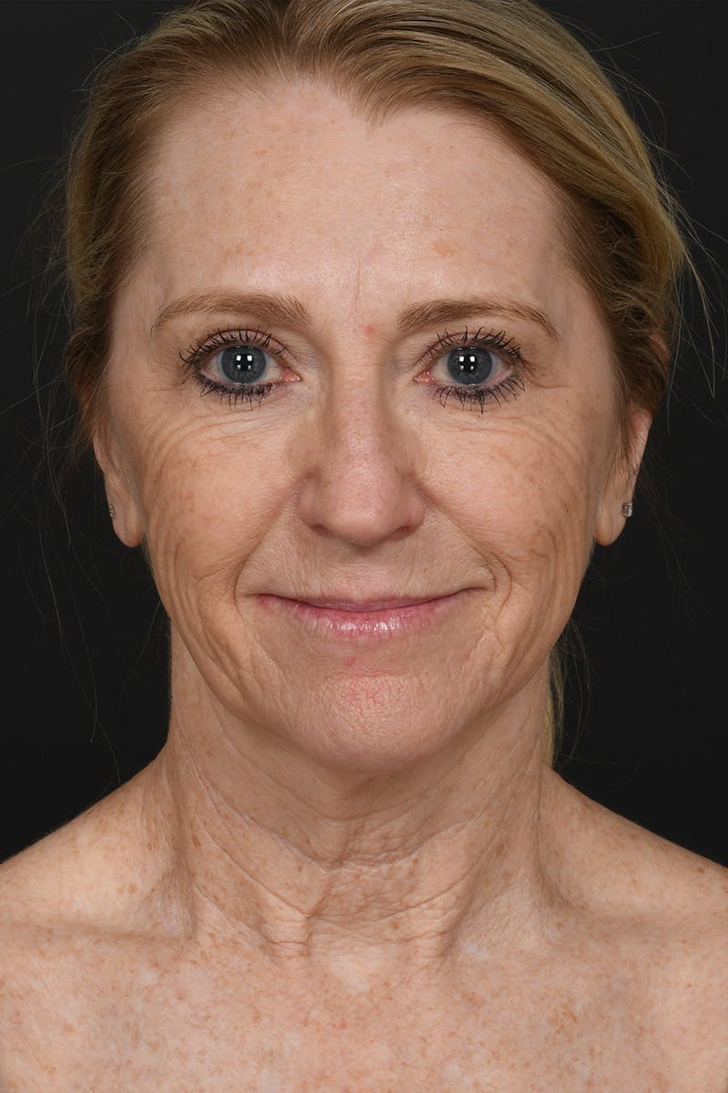 Composite Facelift Before & After Gallery - Patient 198069 - Image 1