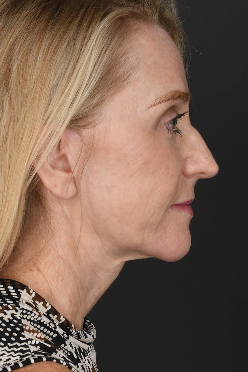 Composite Facelift Before & After Gallery - Patient 198069 - Image 6
