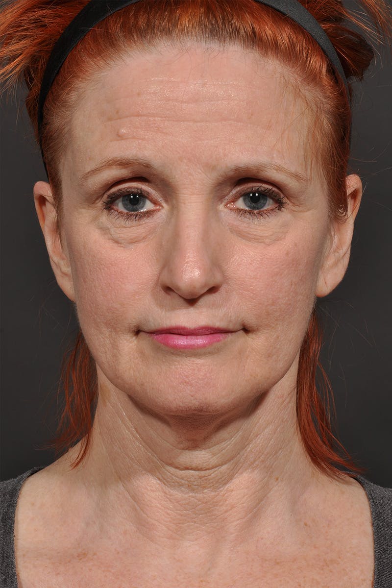 Facelift Before & After Gallery - Patient 542538 - Image 1