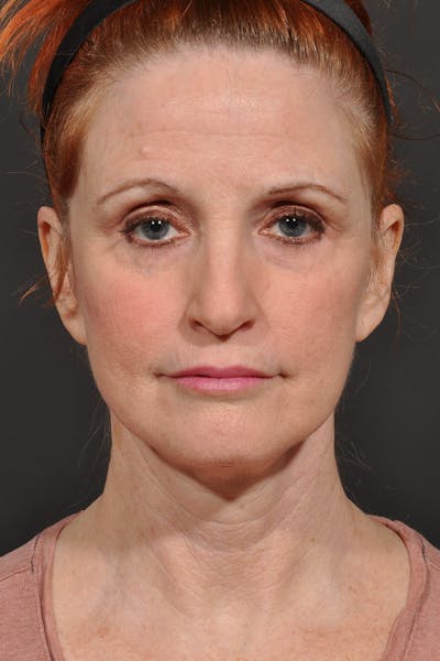 Facelift Before & After Gallery - Patient 542538 - Image 2