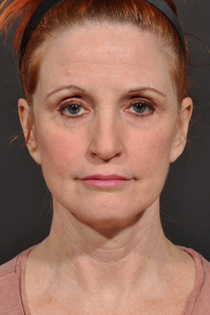 Facelift Before & After Gallery - Patient 542538 - Image 2
