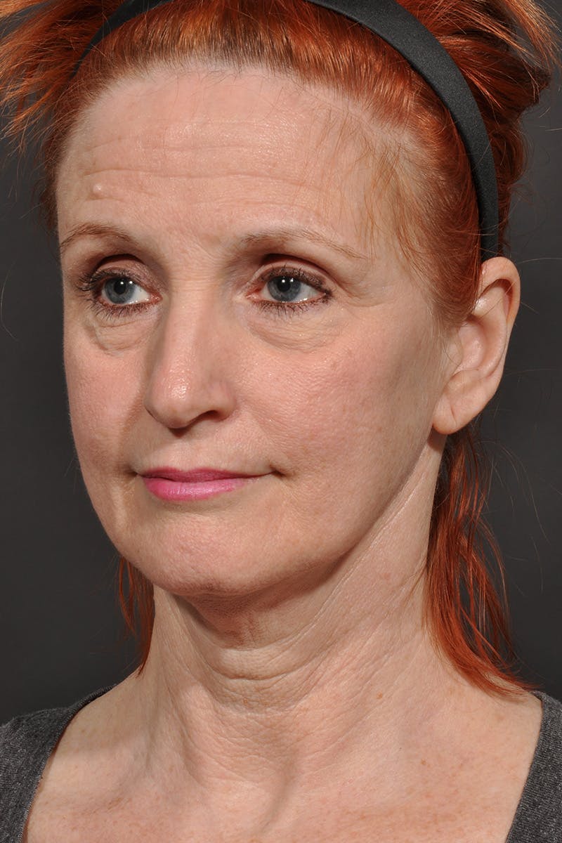 Facelift Before & After Gallery - Patient 542538 - Image 3