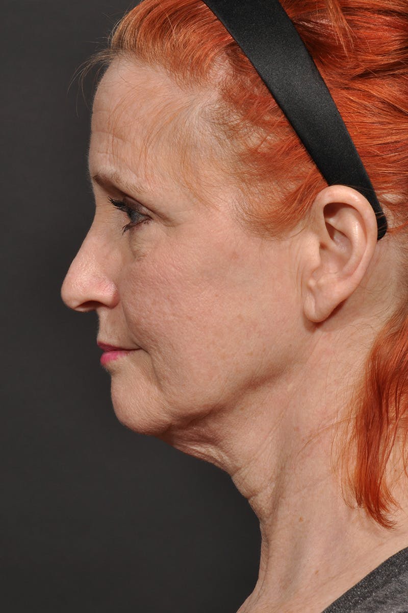 Facelift Before & After Gallery - Patient 542538 - Image 5