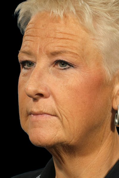 Facelift Before & After Gallery - Patient 272057 - Image 1