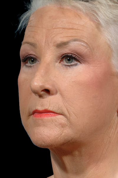 Facelift Before & After Gallery - Patient 272057 - Image 2
