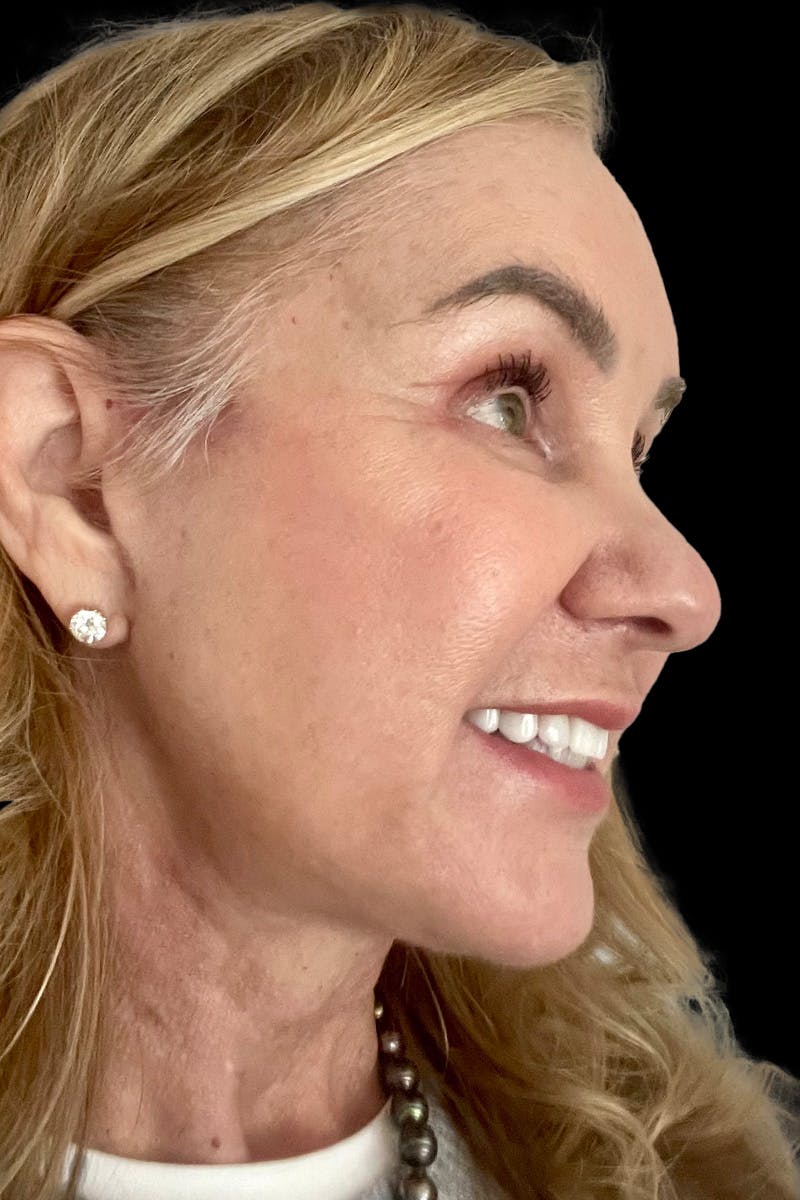 Composite Facelift Before & After Gallery - Patient 498091 - Image 2