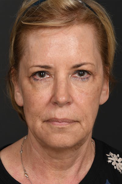 Facelift Before & After Gallery - Patient 414119 - Image 1