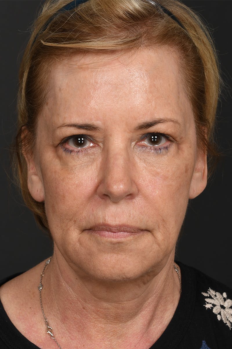 Composite Facelift Before & After Gallery - Patient 306687 - Image 1