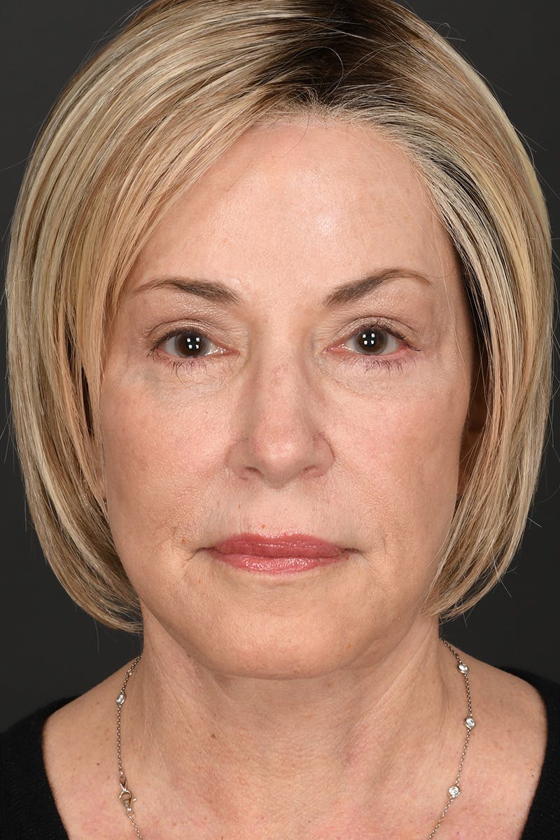 Composite Facelift Before & After Gallery - Patient 306687 - Image 2