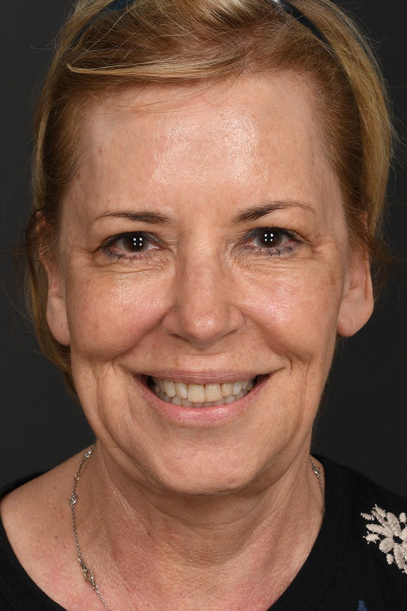 Composite Facelift Before & After Gallery - Patient 306687 - Image 3