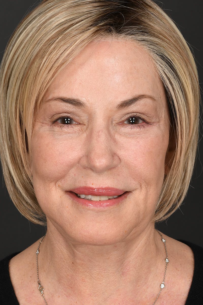 Composite Facelift Before & After Gallery - Patient 306687 - Image 4