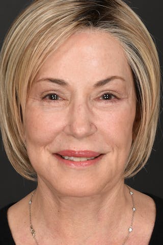 Facelift Before & After Gallery - Patient 414119 - Image 4