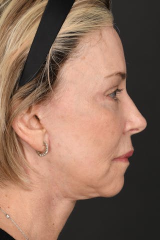 Facelift Before & After Gallery - Patient 414119 - Image 8