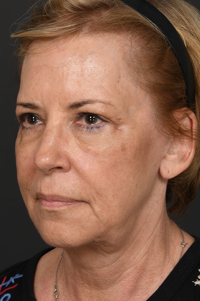 Composite Facelift Before & After Gallery - Patient 306687 - Image 9