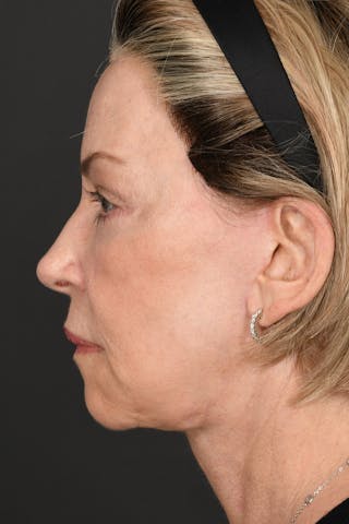 Facelift Before & After Gallery - Patient 414119 - Image 12