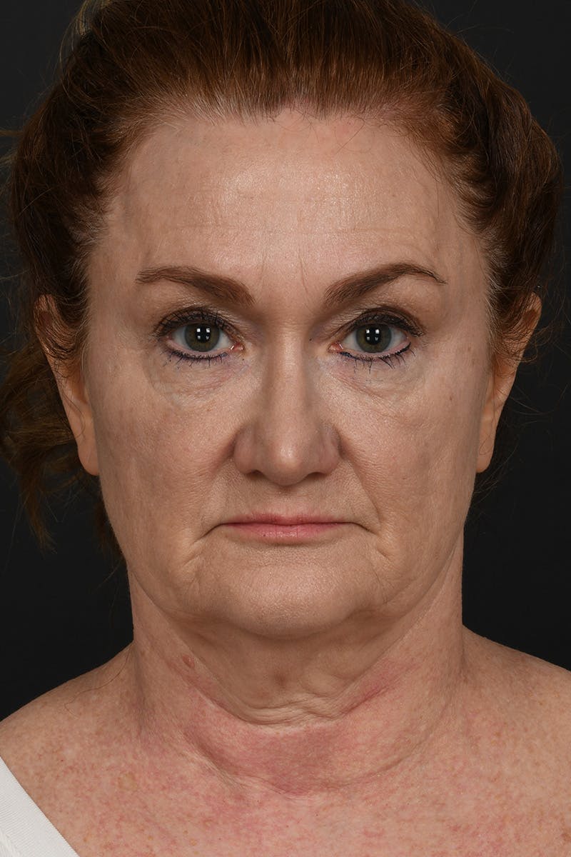 Facelift Before & After Gallery - Patient 535847 - Image 1