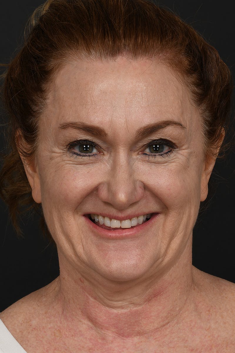 Facelift Before & After Gallery - Patient 535847 - Image 3