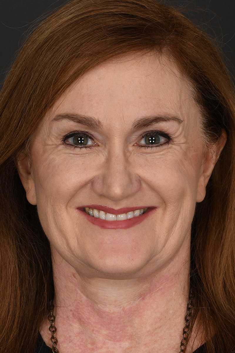 Facelift Before & After Gallery - Patient 535847 - Image 4