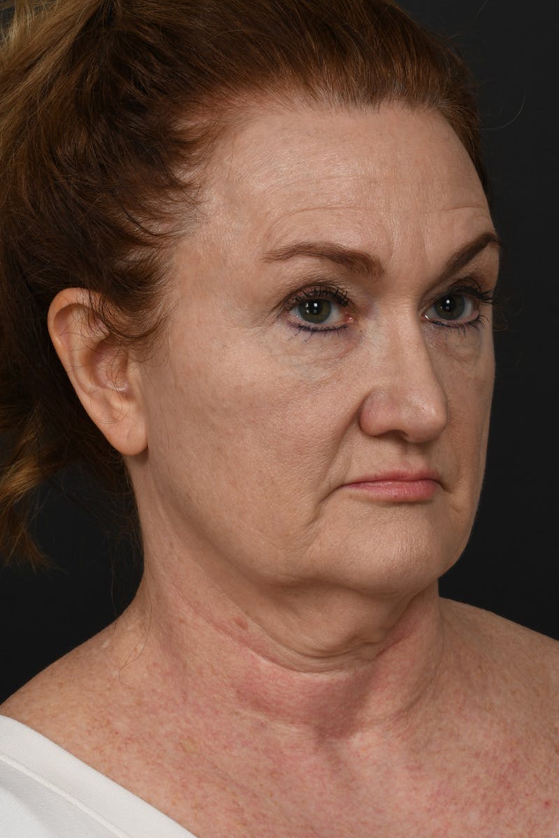 Facelift Before & After Gallery - Patient 535847 - Image 5