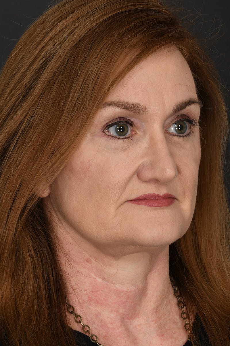Facelift Before & After Gallery - Patient 535847 - Image 6