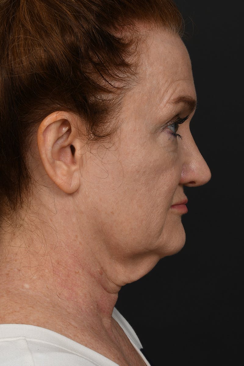 Facelift Before & After Gallery - Patient 535847 - Image 7