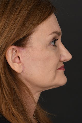 Facelift Before & After Gallery - Patient 535847 - Image 8