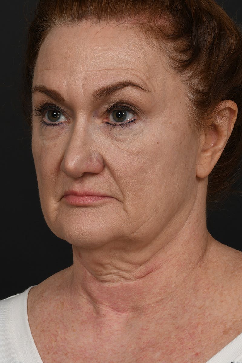 Facelift Before & After Gallery - Patient 535847 - Image 9